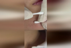 挤痘痘视频,专业视频教你正确操作